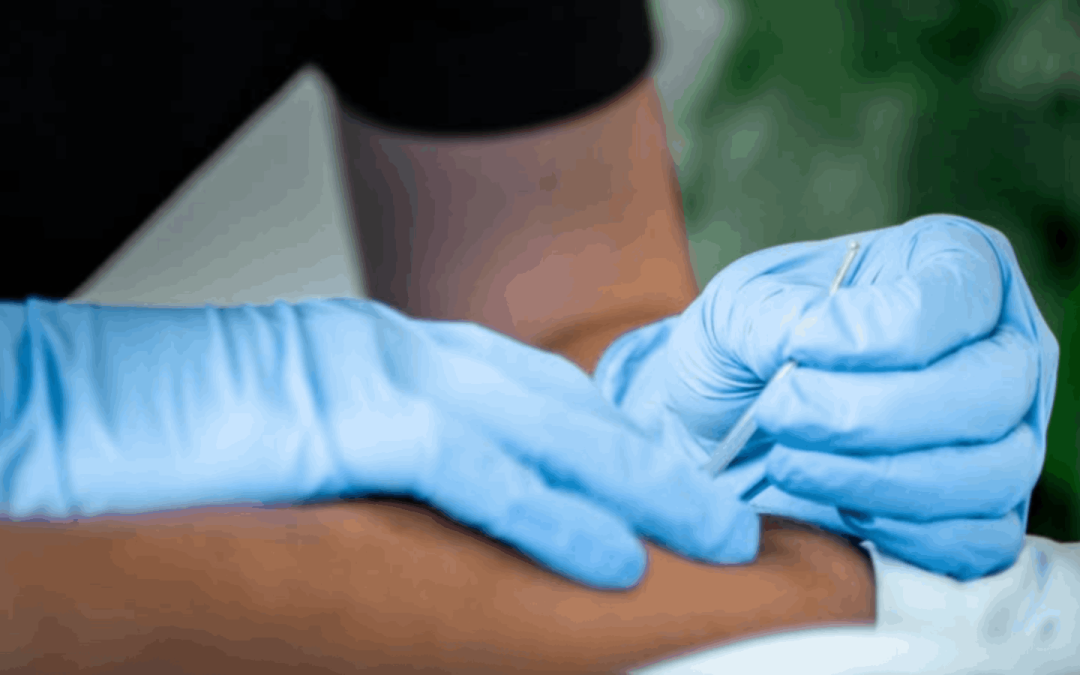 Dry Needling vs Acupuncture: What’s the Difference?
