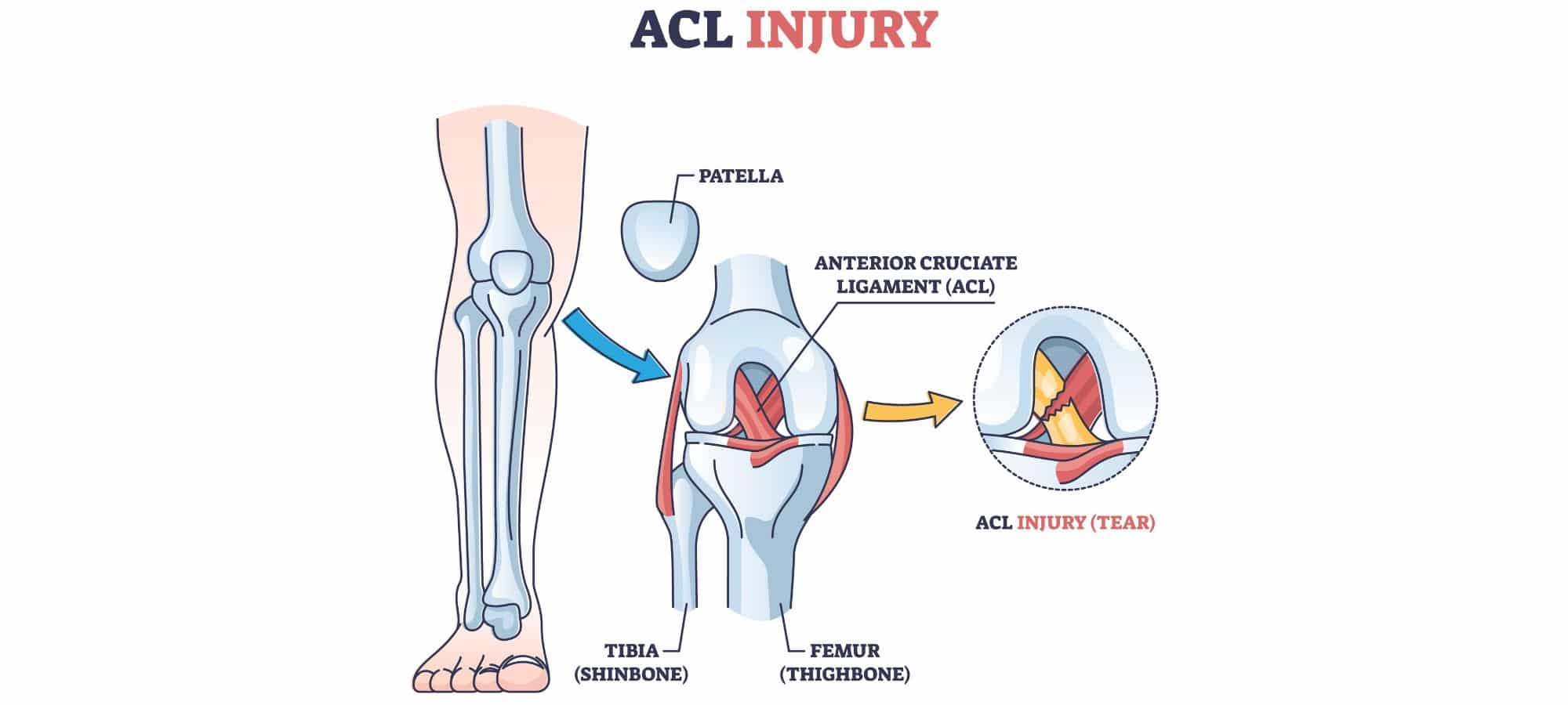 acl tear acl tear