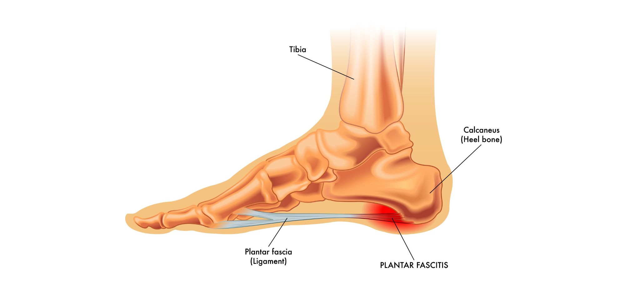 plantar fasciitis plantar fasciitis
