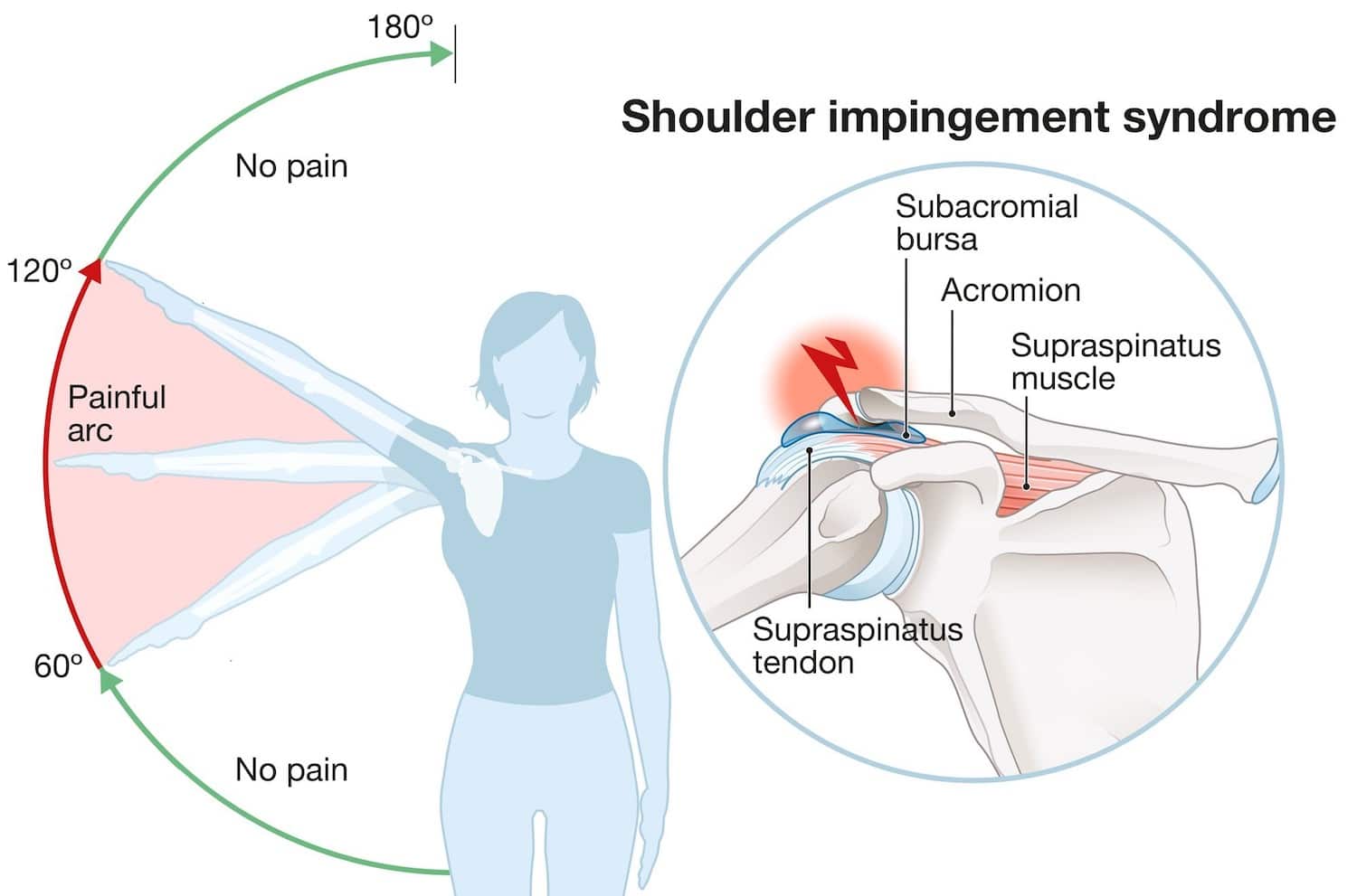 shoulder impingement syndrome shoulder impingement syndrome